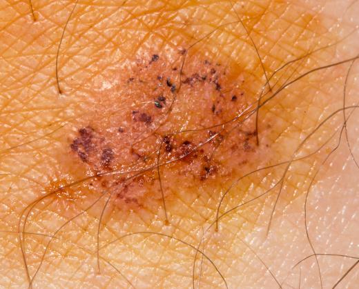 Skin diseases such as ringworm can thrive on wrestling mats.